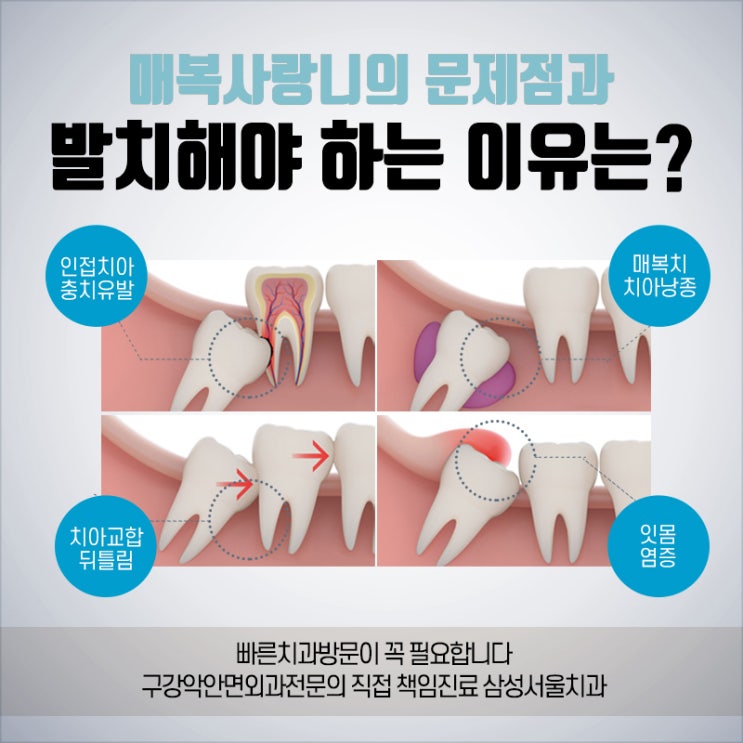  원주 매복 사랑니 당일발치, 원주 무실동 삼성서울치과 사랑니 발치 증례
