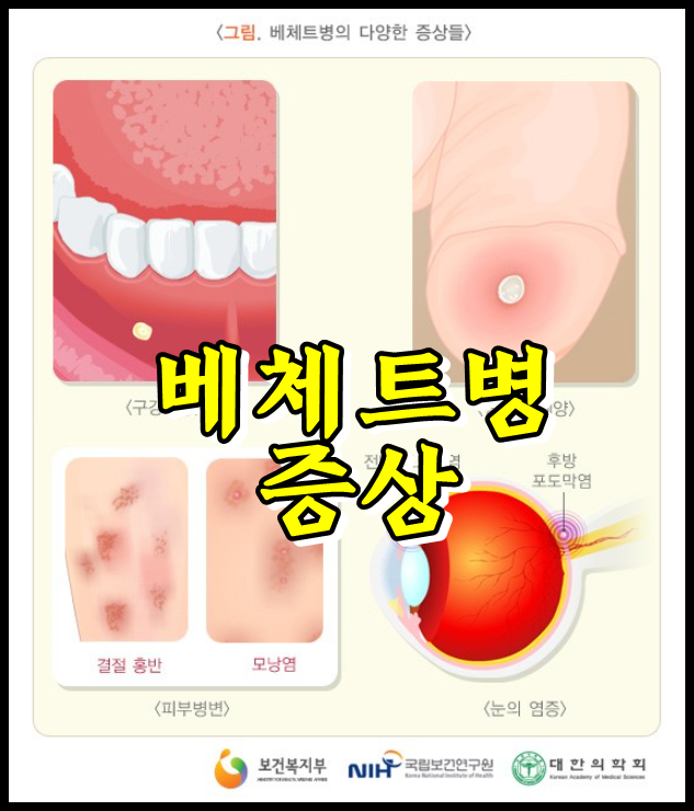  베체트병 증상, 포도막염 치료, 구강궤양 합병증 조심하세요.