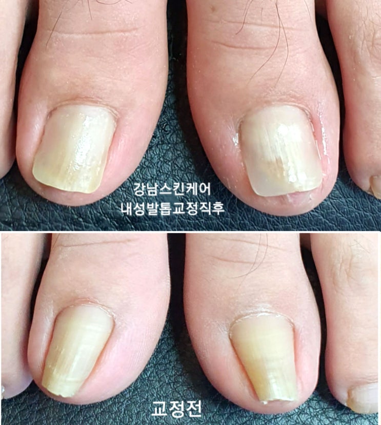  서귀포시 서귀동 내성발톱교정&네일샵 제주도민 최대 55% 할인쿠폰 정보!