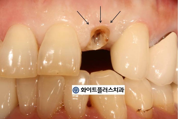 신길치과 보철치료 자연치아 살리기