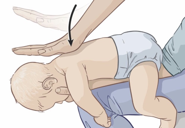 하임리히법 유아 기도폐쇄시 응급처치방법(하임리히 요법)