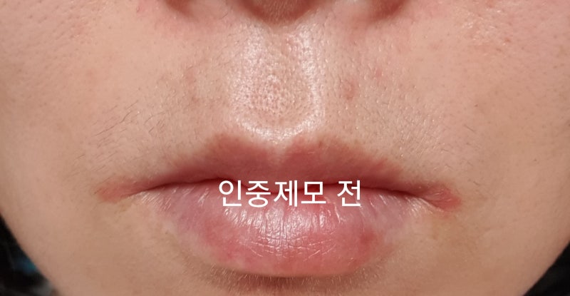 피부과 남성 수염 레이저 제모 주기 가격 인중 탈모 턱모낭염없음 3차 3주후기 스플렌더X추천
