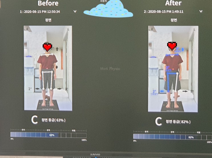  [일산척추교정][일산체형교정][파주척추교정][파주체형교정][일산도수치료][파주도수치료] 이00고객님 체형교정 비교