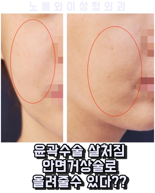  안면윤곽 살처짐 올려주는 방법 있을까?