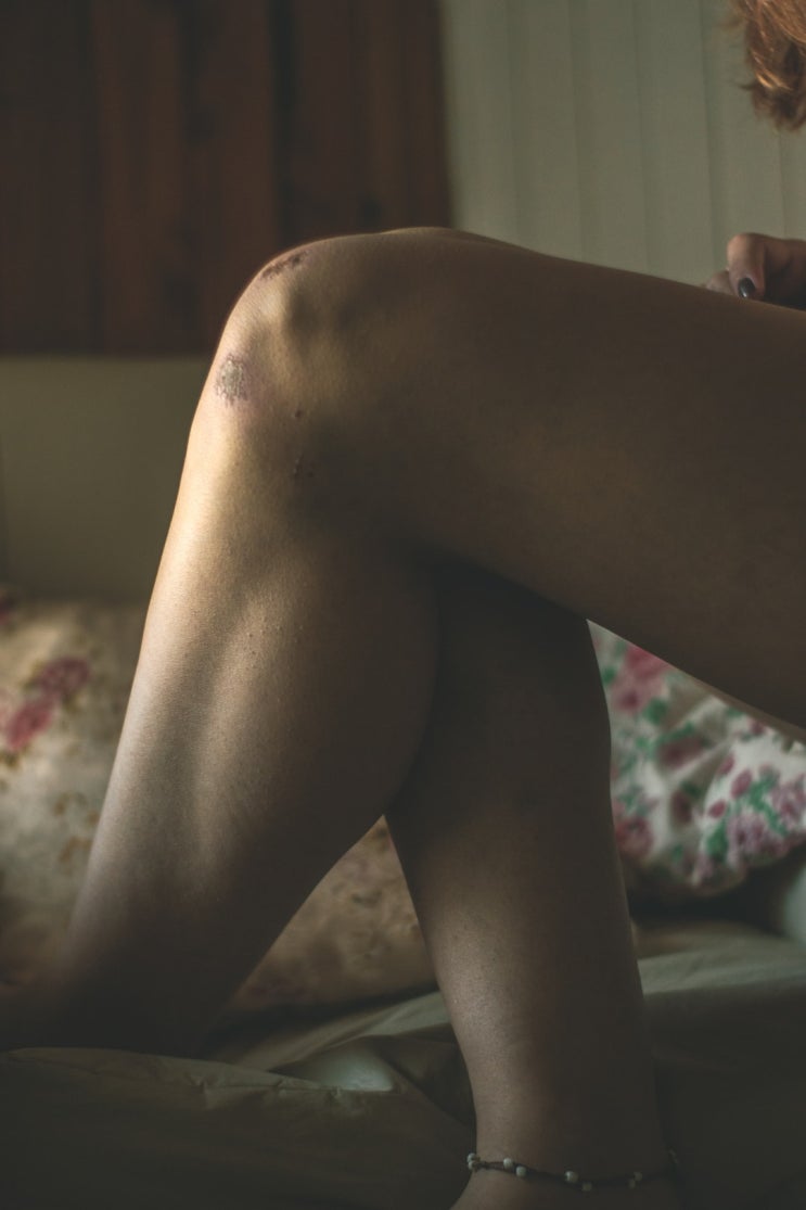  무릎 인공관절 수술 후 1년만에  재치환술을 받은 경우 수술비 추가 지급 여부