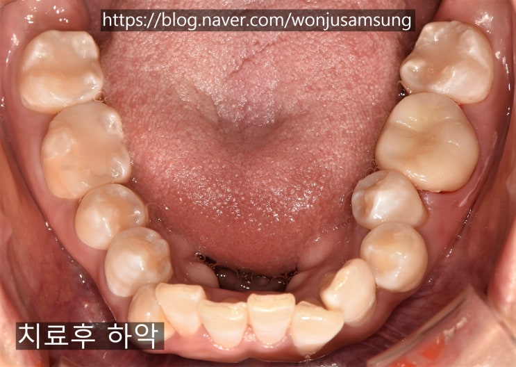  교정 전 환자 충치 치료 마무리, 원주 무실동 삼성서울치과 충치치료하기, 원주 충치치료 잘하는 곳