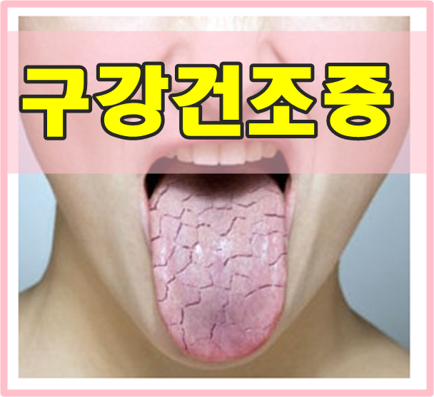  나도 구강건조증일까? 증상과 치료방법은??
