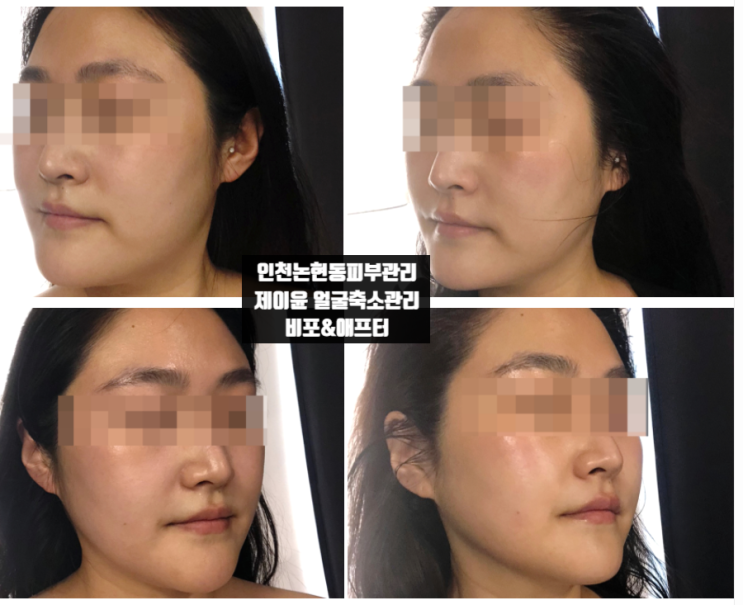  인천논현동피부관리 제이윤 얼굴축소관리 비포애프터 대박