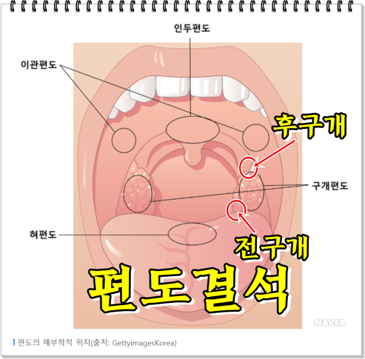 목구멍 편도결석 빼는법