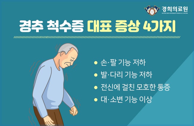 목에 생기는 중풍 '경추 척수증' 자가 진단법 & 치료 / 정형외과 강경중 교수 : 네이버 블로그 목에 생기는 중풍 '경추 척수증' 자가 진단법 & 치료 / 정형외과 강경중 교수 : 네이버 블로그