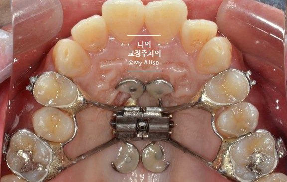 주의사항 2. 급속구개확장장치(Rapid palatal expansion; RPE) 교정 장치 주의사항 / 미사교정치과 / 연세꿈꾸는아이치과 주의사항 2. 급속구개확장장치(Rapid palatal expansion; RPE) 교정 장치 주의사항 / 미사교정치과 / 연세꿈꾸는아이치과