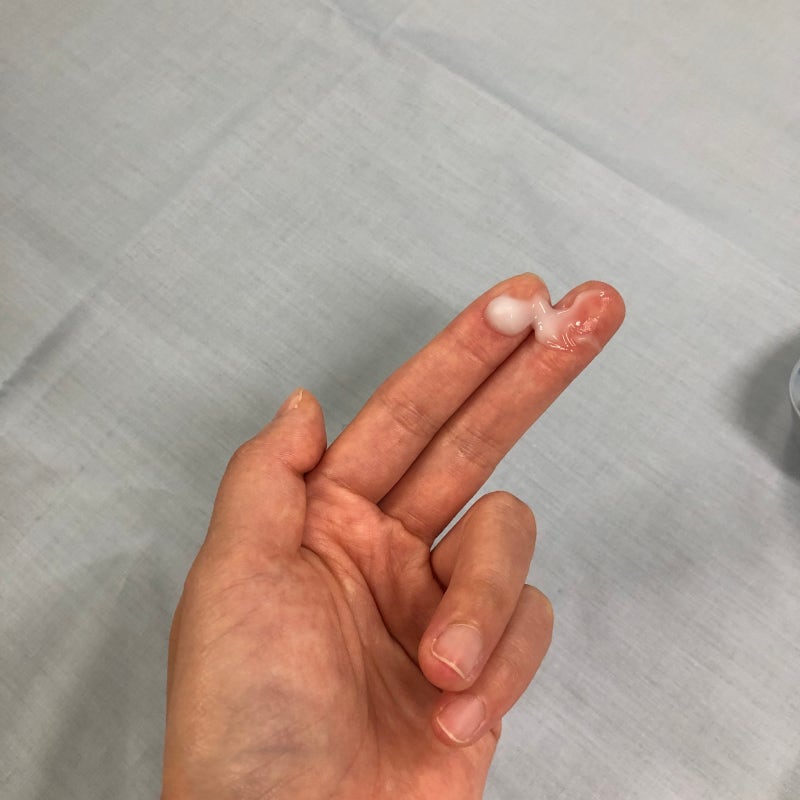 손가락 습진, 연고에만 의존하고 5