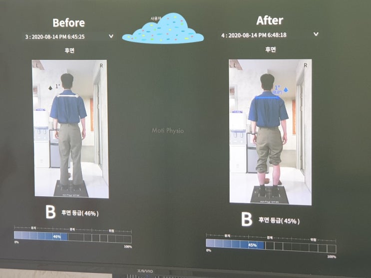  [일산척추교정][일산체형교정][파주척추교정][파주체형교정][일산도수치료][파주도수치료] 문00고객님 체형교정 비교