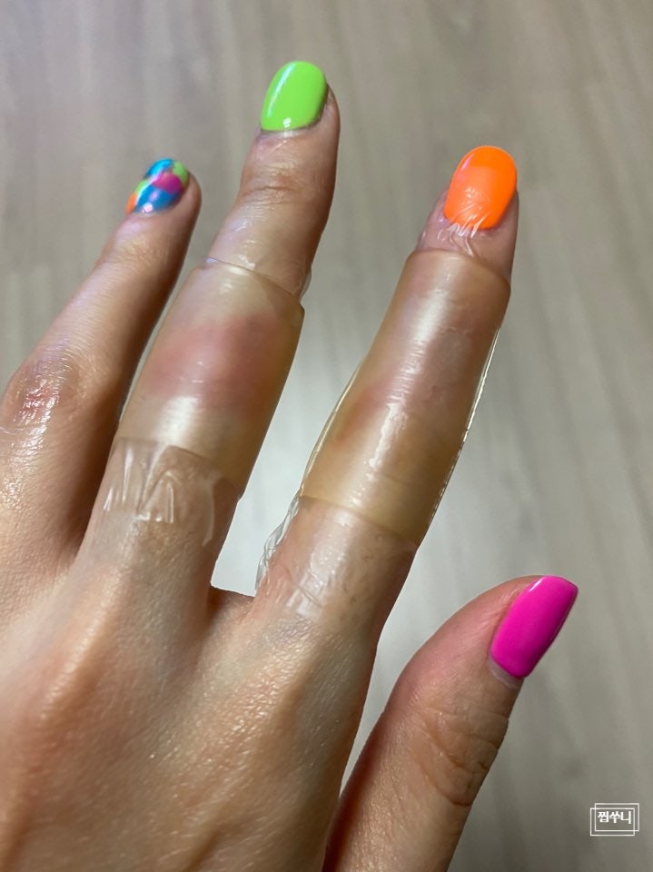 화상밴드 사용해서 뜨거운물 화상 자가치료(응급처치 포함)