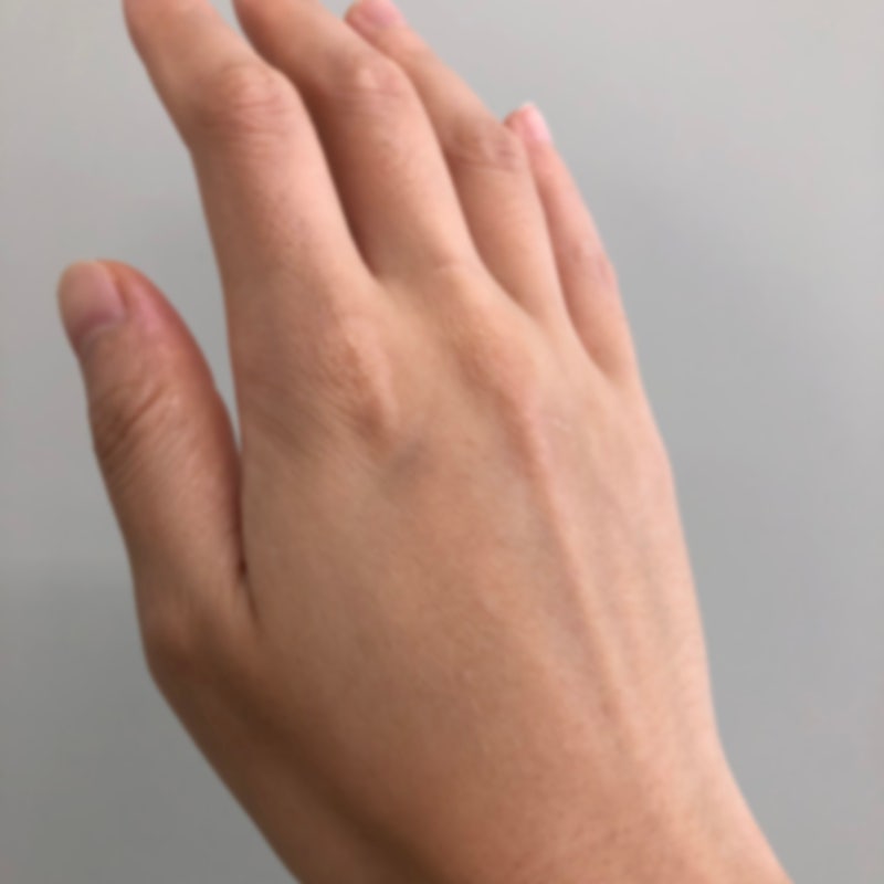손가락 습진, 연고에만 의존하고 2