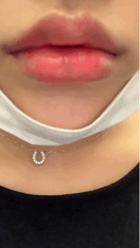  입술필러+입꼬리 후기!!!