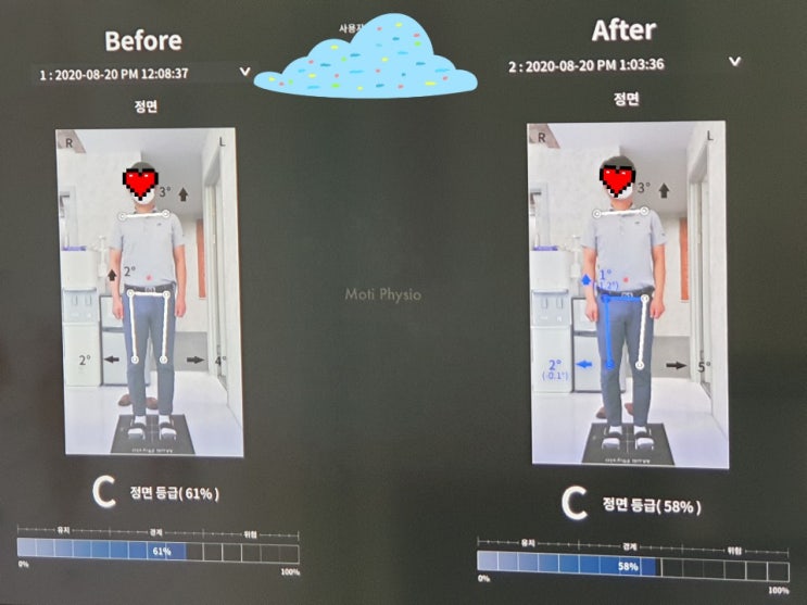  [일산척추교정][일산체형교정][파주척추교정][파주체형교정][일산도수치료][파주도수치료] 조00고객님 체형교정 비교