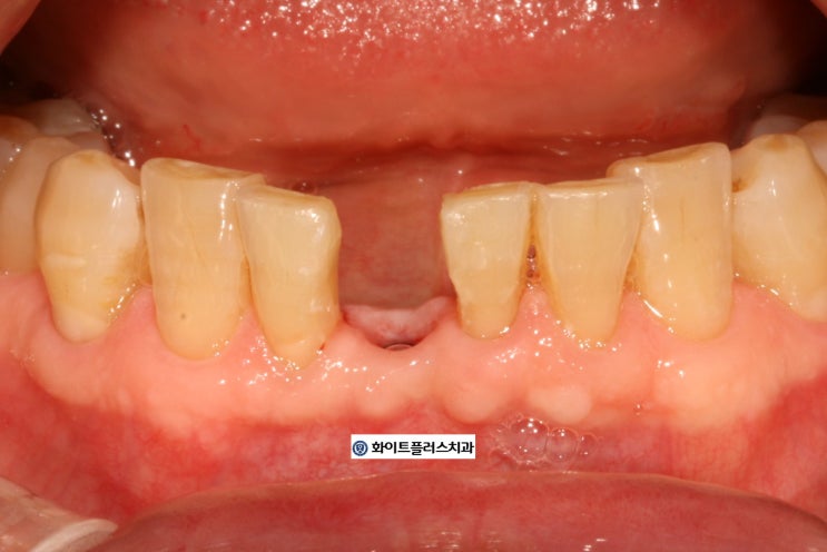 아래 앞니도 임플란트가 가능할까? 수술시 고려사항, 보라매치과