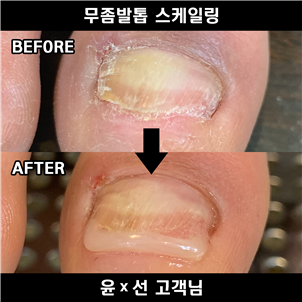 부천 무좀발톱 발톱쟁이(페디아이티엔)에서 관리 받으세요!