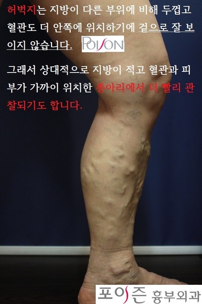 대전하지정맥류 다리의 부종과 피로감이 나타나면 8