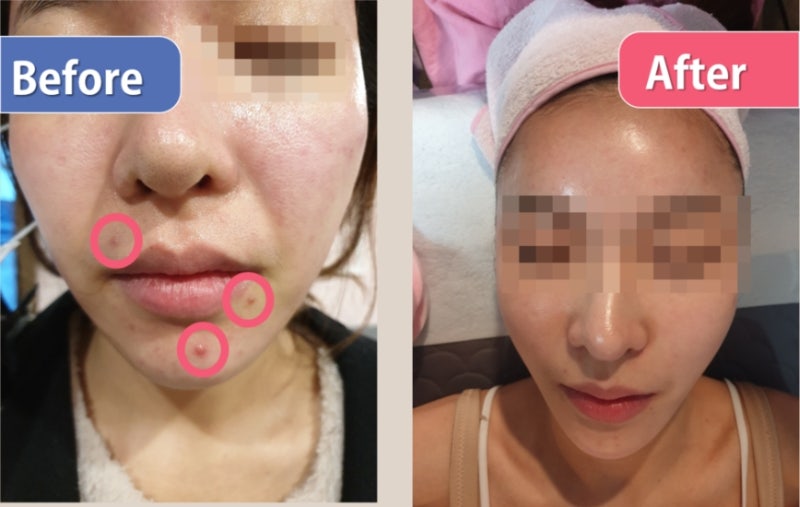 여드름 압출 후에는 사후관리가 필수적입니다