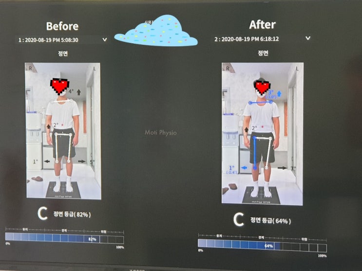  [일산척추교정][일산체형교정][파주척추교정][파주체형교정][일산도수치료][파주도수치료] 정00고객님 체형교정 비교