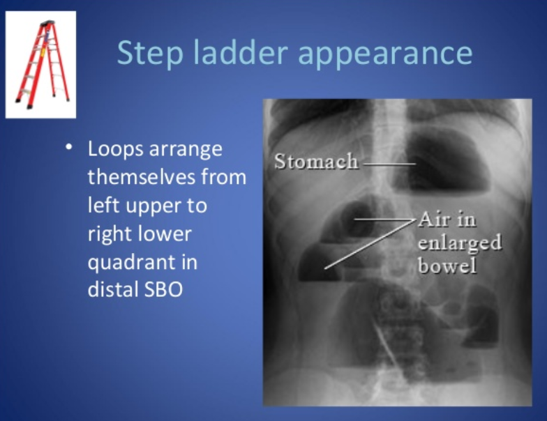 장폐색(bowel obstruction)이 있는 대장암의 수술적 치료는? 네이버 블로그