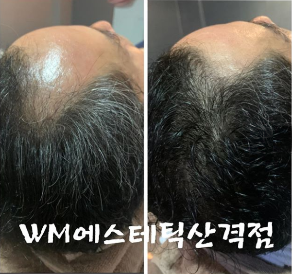  M자 탈모와 정수리 탈모 전/후 사진더블유엠 산격점 두피 탈모관리