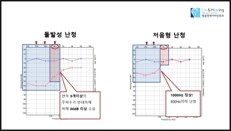 돌발성 난청 치료와 급성 저음성 난청 치료 : 네이버 블로그