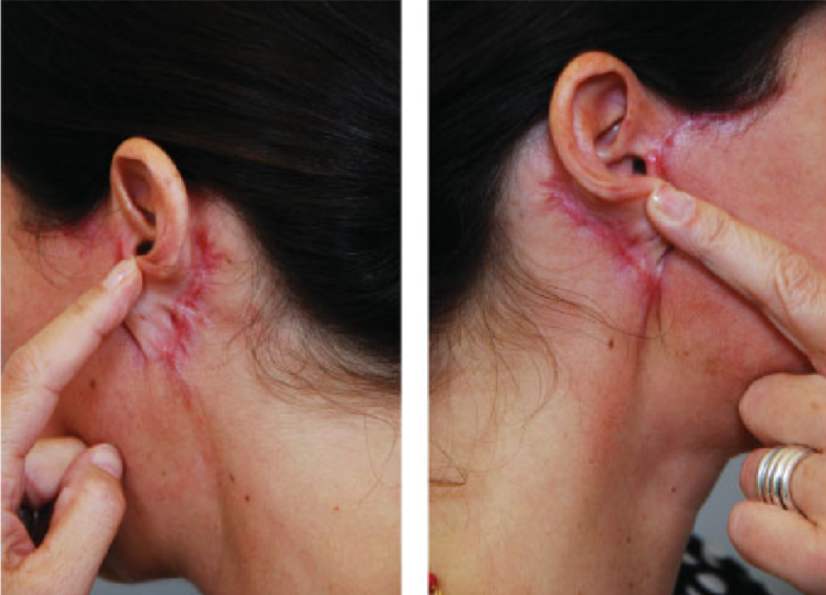  안면거상(Face lift, Rhytidectomy)에 대하여 성형외과 전문의가 알려드립니다.