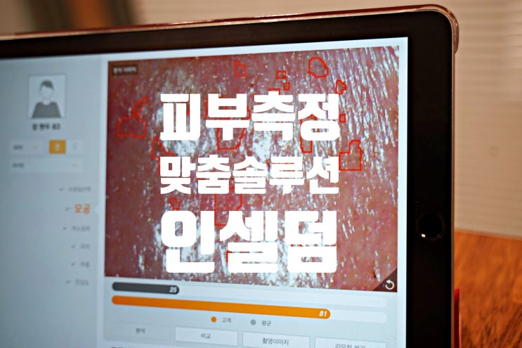  인셀덤화장품 후기: 남성피부측정 맞춤솔루션 제안, 모공 피지 여드름 색소침착 제거