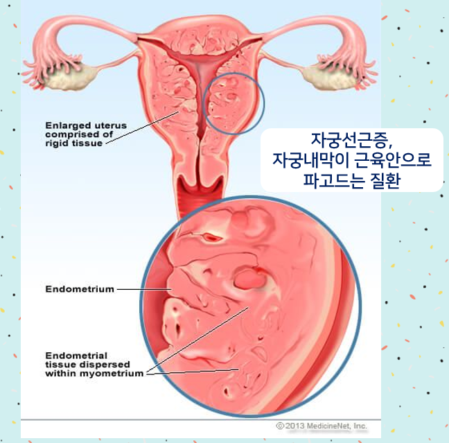 초기 Matsushima adenomyosis의 적절한 치료 6