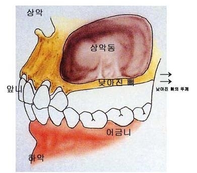  원주 삼성서울치과 상악동 골이식술 증례, 원주 무실동 치과