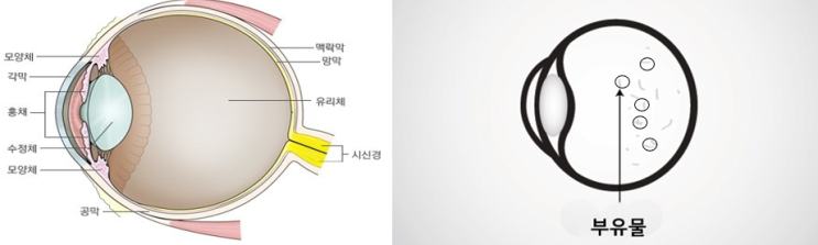  비문증이 너무 심해요 (with, 날파리 증상)