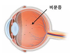  비문증 혼탁 날파리증 눈에 아지랑이 검은물체 : 비문증원인 증상 치료방법 비문증케이스간호