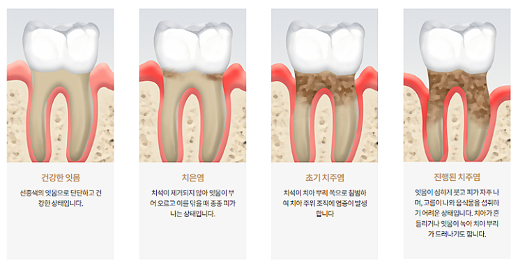  원주에서 잇몸치료가 필요하다면, 무실동 삼성서울치과