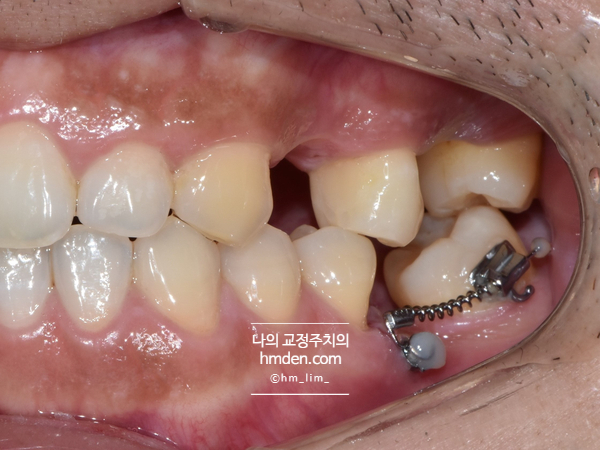 어금니가 없는경우 생기는 문제점 2탄 /  어금니쓰러짐, 쓰러진 어금니 치료 방법, 구치부 직립(molar uprighting), 어금니 세우기, 미사교정치과