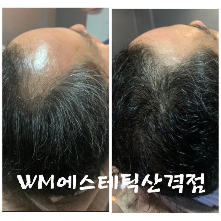  대구탈모 관리의 확실한 효과! 많은 고객님들이 믿고  찾는 더블유엠 산격점