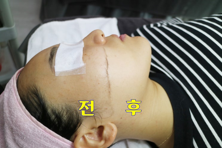  낙성대크라이오더마플래닝 제니뷰티에서 받은 후기