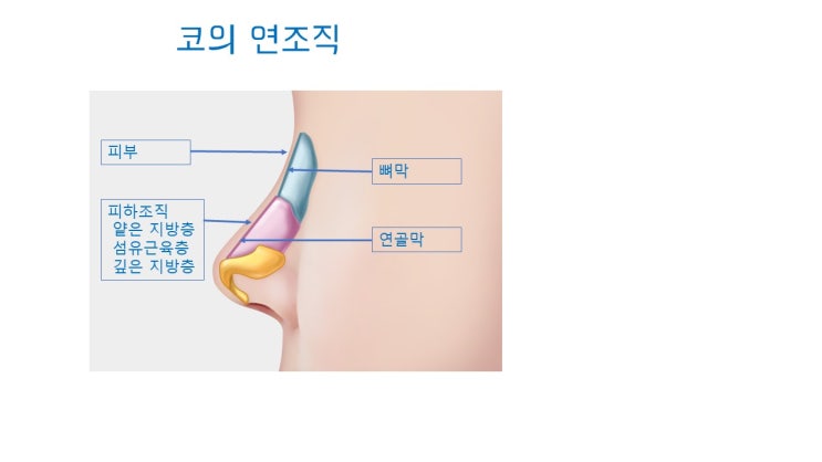  코보형물 움직임도 잘 못된 코수술 결과
