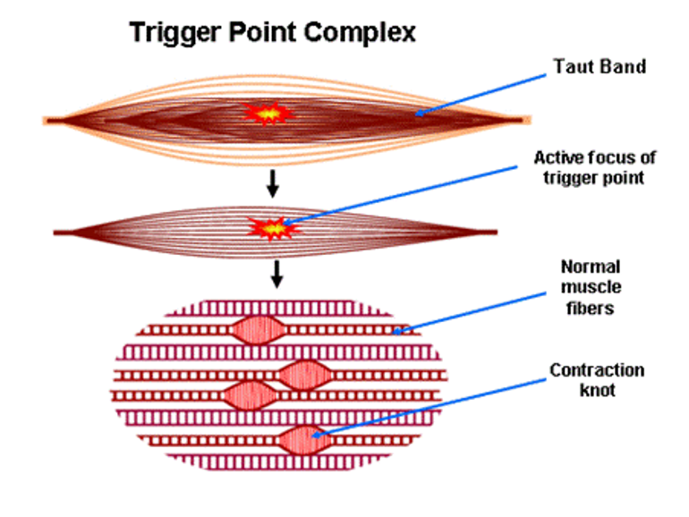 MPS : Myofascial Pain Syndrome & TrP: Trigger Point – 근막통증증후군과 트리거포인트 ...