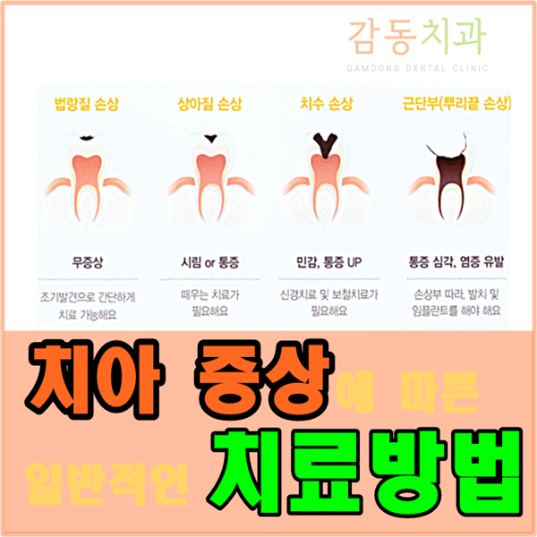  치아증상에따른 치료방법*언제,어떻게 치료해야할까?