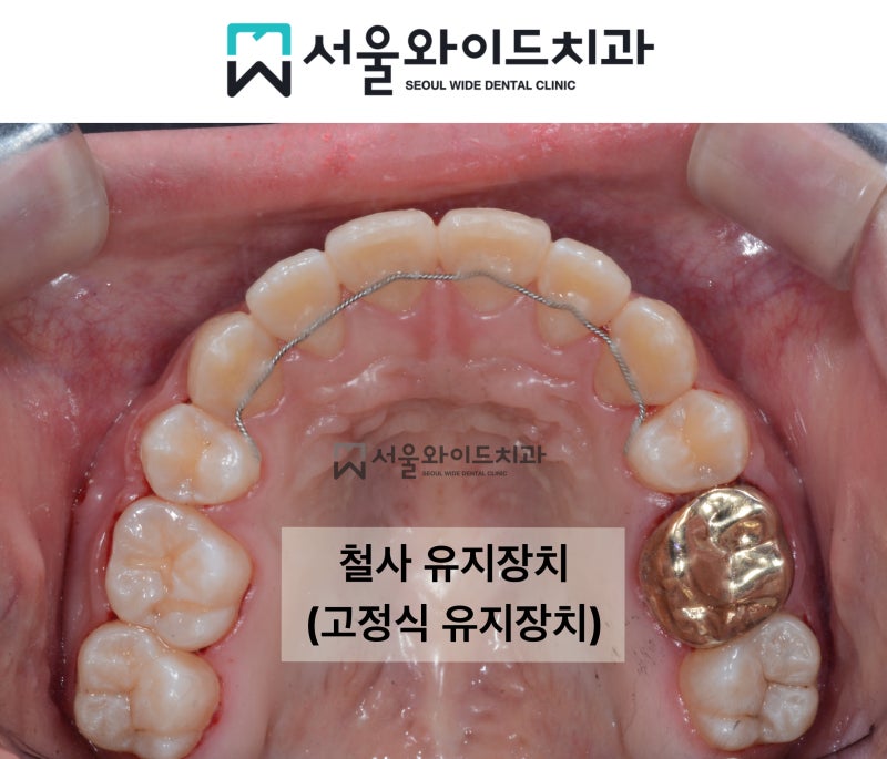 교정 후 부착하는 유지장치는 언제까지? 고정식 철사 떨어짐, 재부착에 대해 : 네이버 블로그 교정 후 부착하는 유지장치는 언제까지? 고정식 철사 떨어짐, 재부착에 대해 : 네이버 블로그