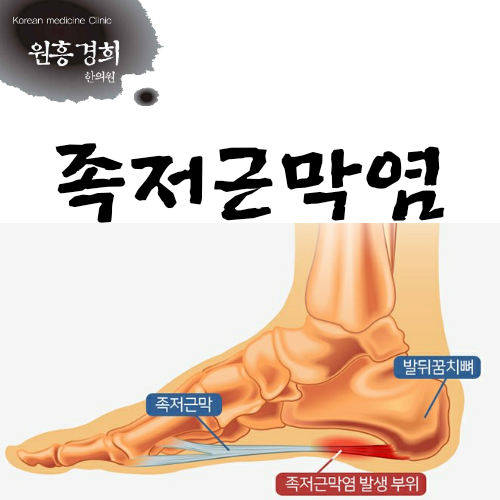  족저근막염