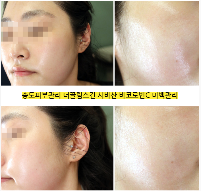  송도피부관리 더끌림스킨 시바산바로코빈C 미백관리 후기