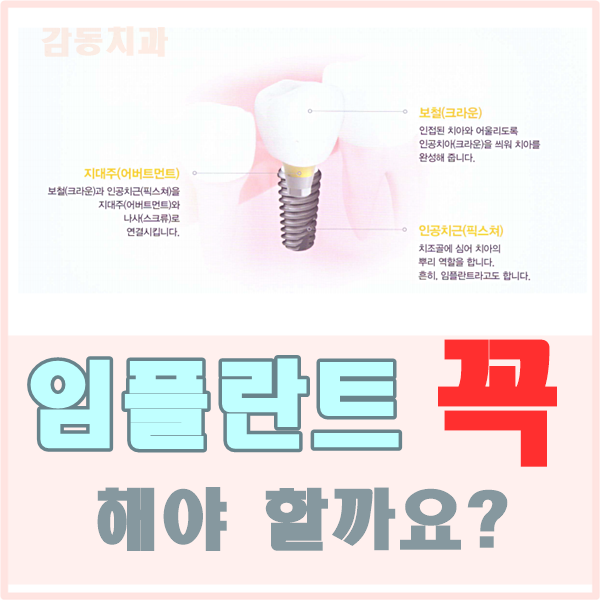  임플란트 꼭 해야 하나요? 빠진 이 방치하게 되면?