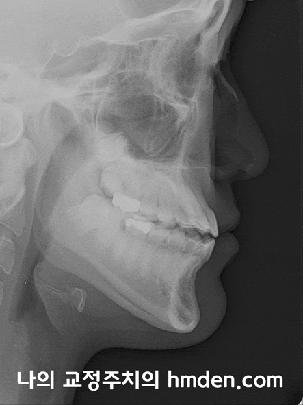 미사교정치과)아래턱(하악) 치아 후방이동을 통한 비발치 교정, 치아 후방 이동시 주의해야 할점, 장치 선택에 대한 고려