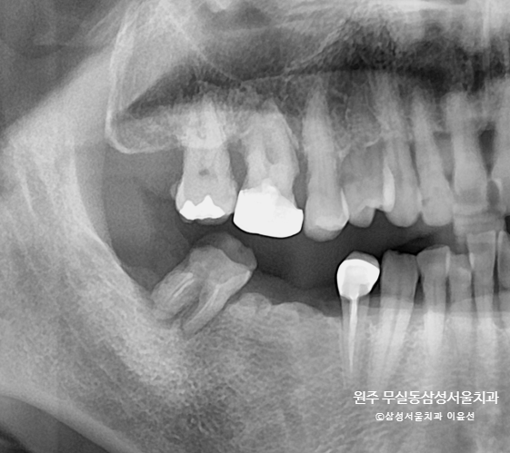  하악 임플란트 브릿지, 상악 신경치료 + 크라운 치료, 원주 치과 잘하는곳