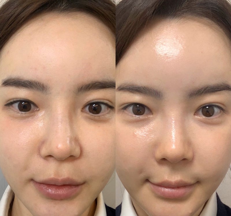 잠실피부과 인트라셀 내 돈 네핏 리뷰 가격! 2