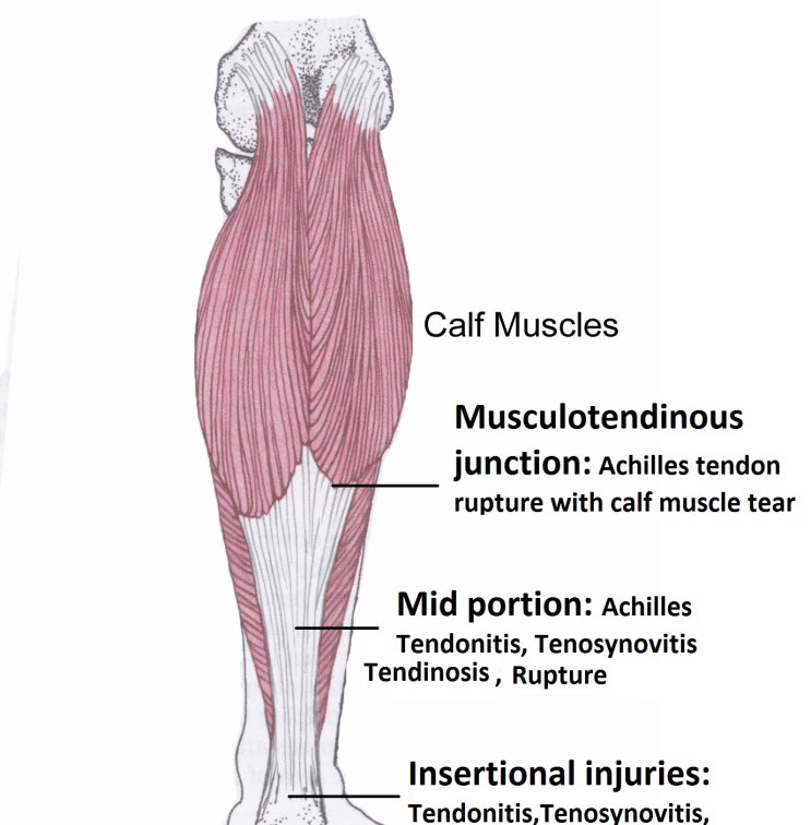 종아리 근육파열, 근막파열